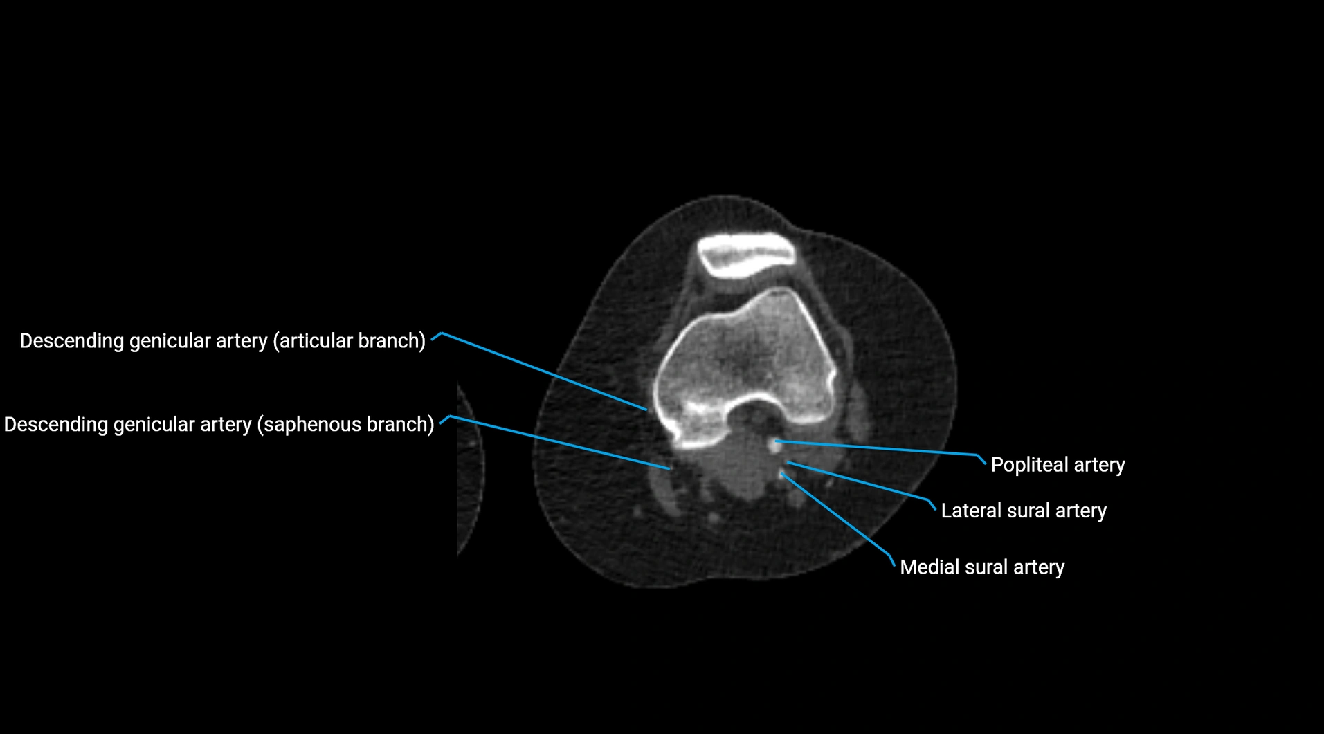 CTA lower limb cross sectional anatomy labelled image _169.webp